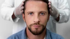 Hair Transplants