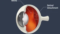 Retinal Detachment