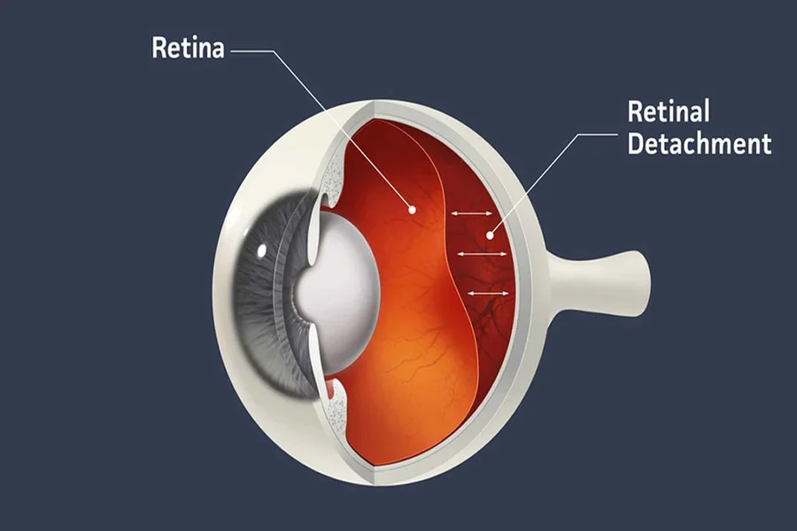 Retinal Detachment