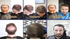 Hair Transplants