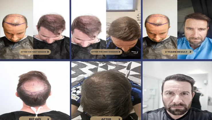 Hair Transplants