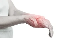 Nerve Damage